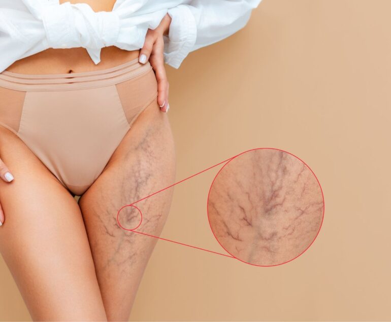 Come applicare correttamente una medicazione avanzata su una lesione trofica