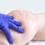 Quali servizi offrono le strutture sanitarie per la diagnosi della trombosi venosa profonda