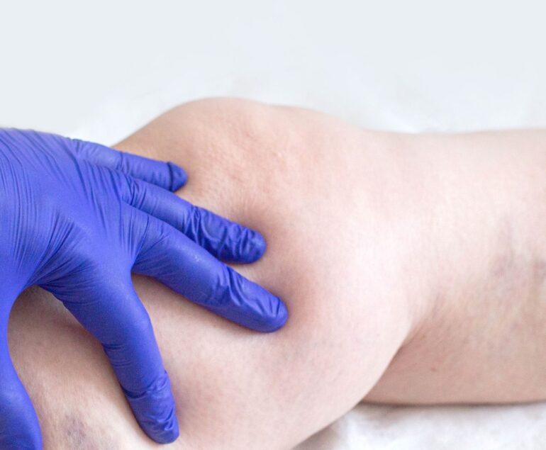 Quali servizi offrono le strutture sanitarie per la diagnosi della trombosi venosa profonda