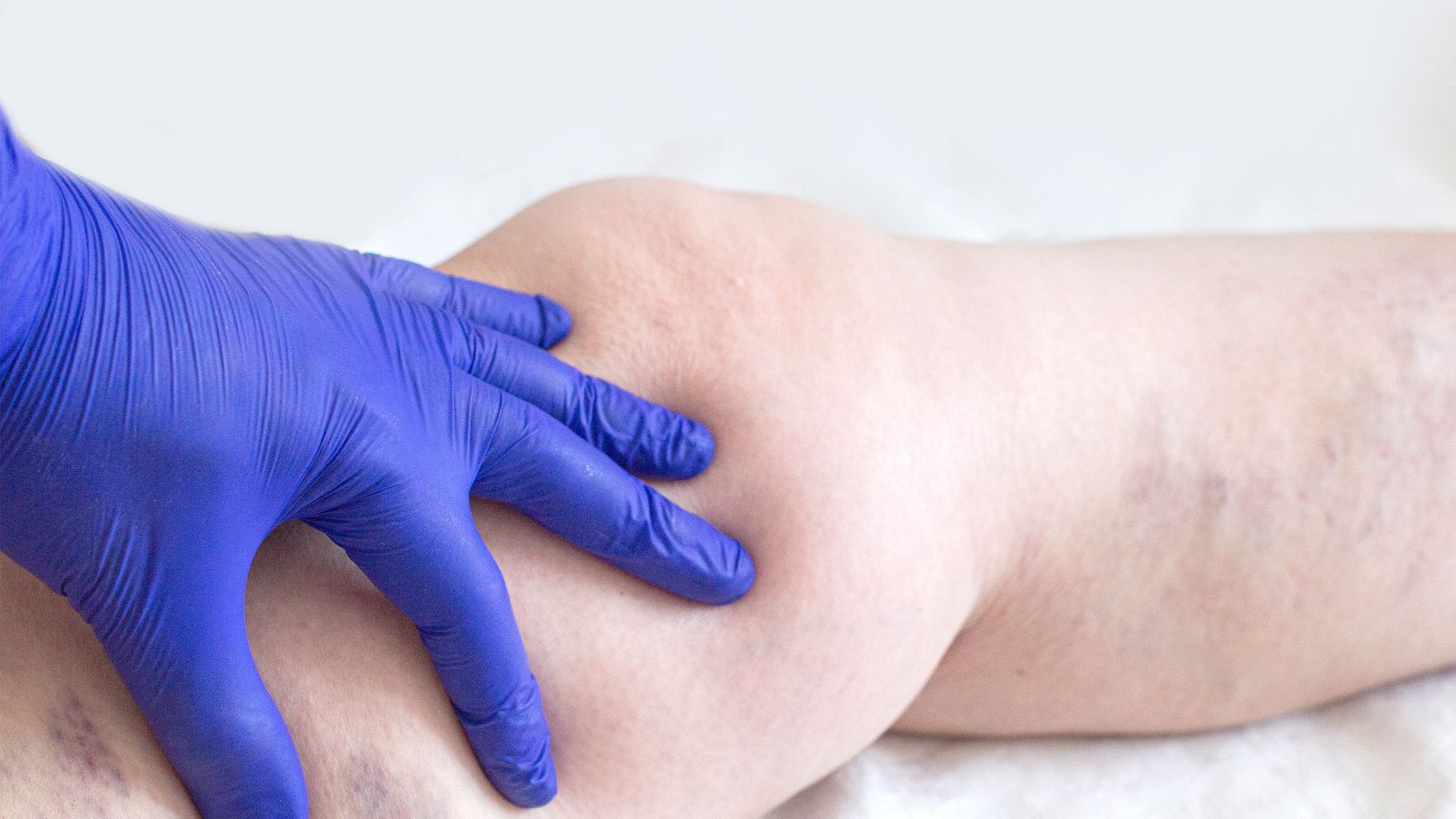 Quali servizi offrono le strutture sanitarie per la diagnosi della trombosi venosa profonda