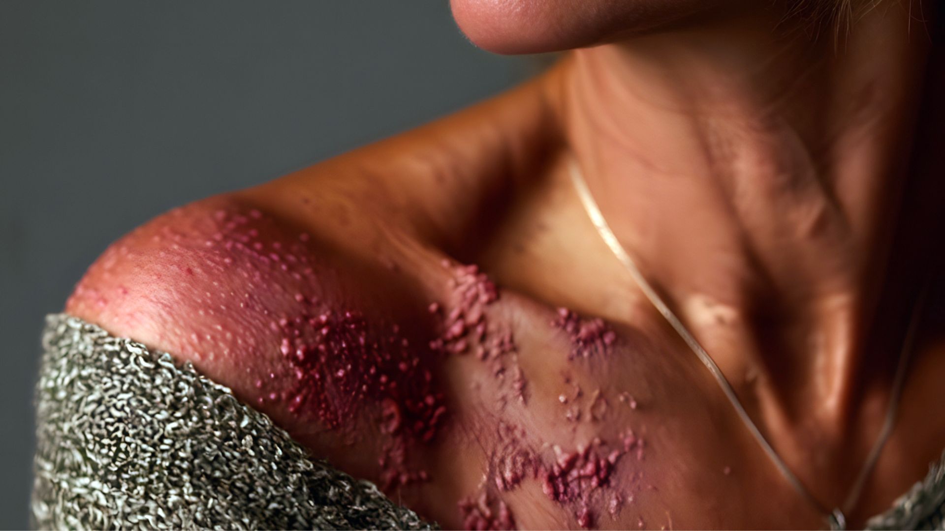 Quali sono i migliori trattamenti disponibili per una lesione trofica?