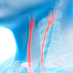 Stenosi carotidea 30 per cento