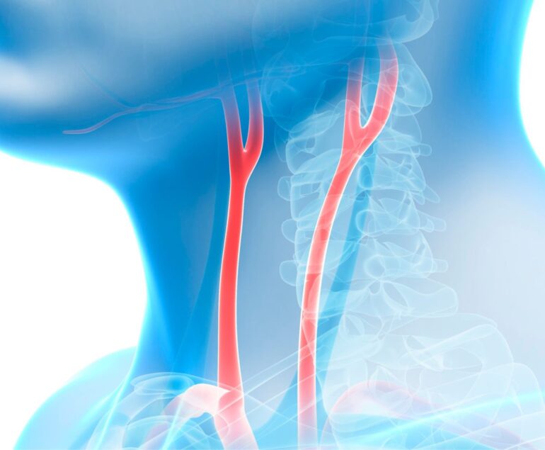 Stenosi carotidea 30 per cento