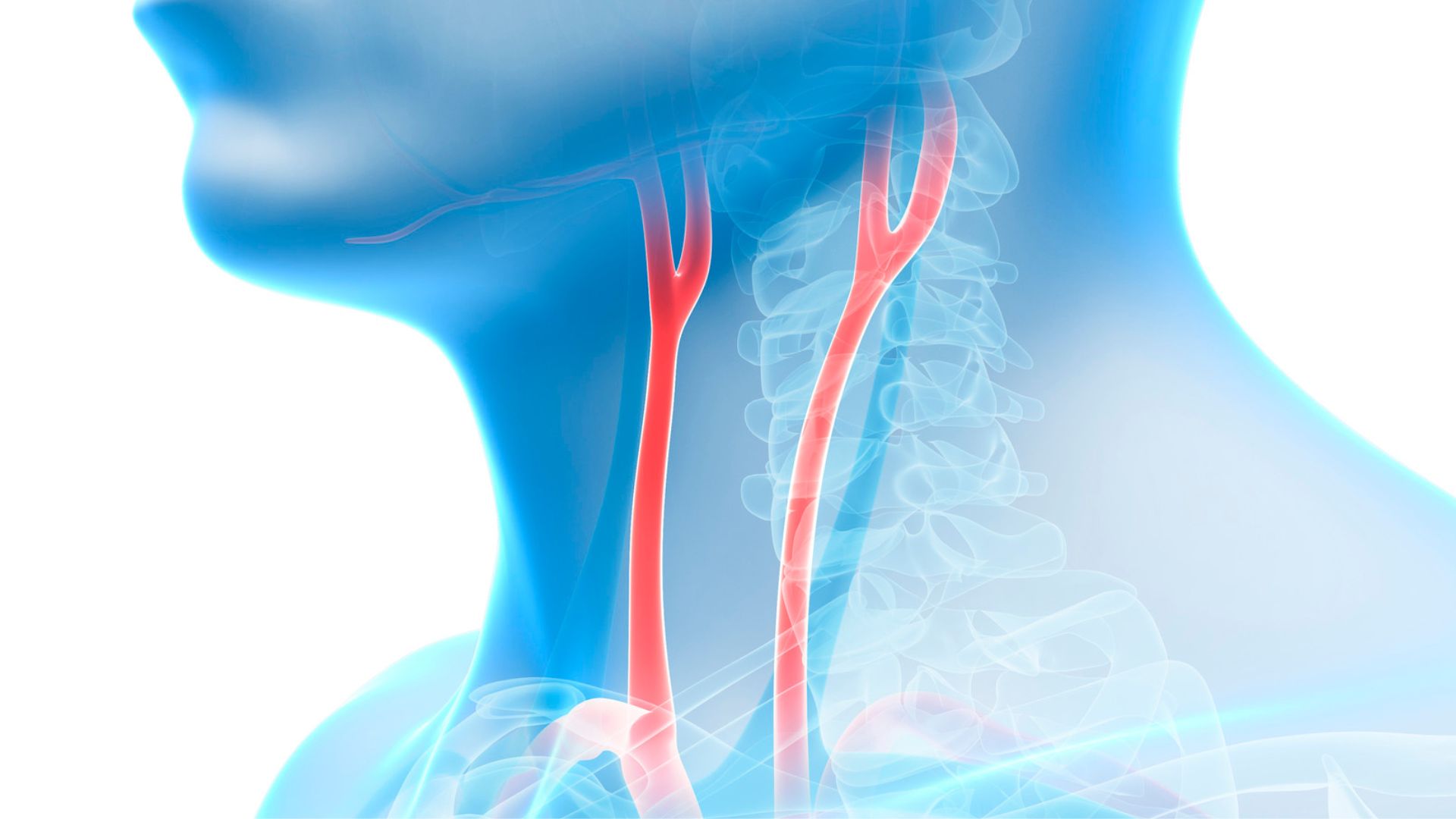 Stenosi carotidea 30 per cento