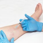 Come funziona la scleroterapia per le vene varicose