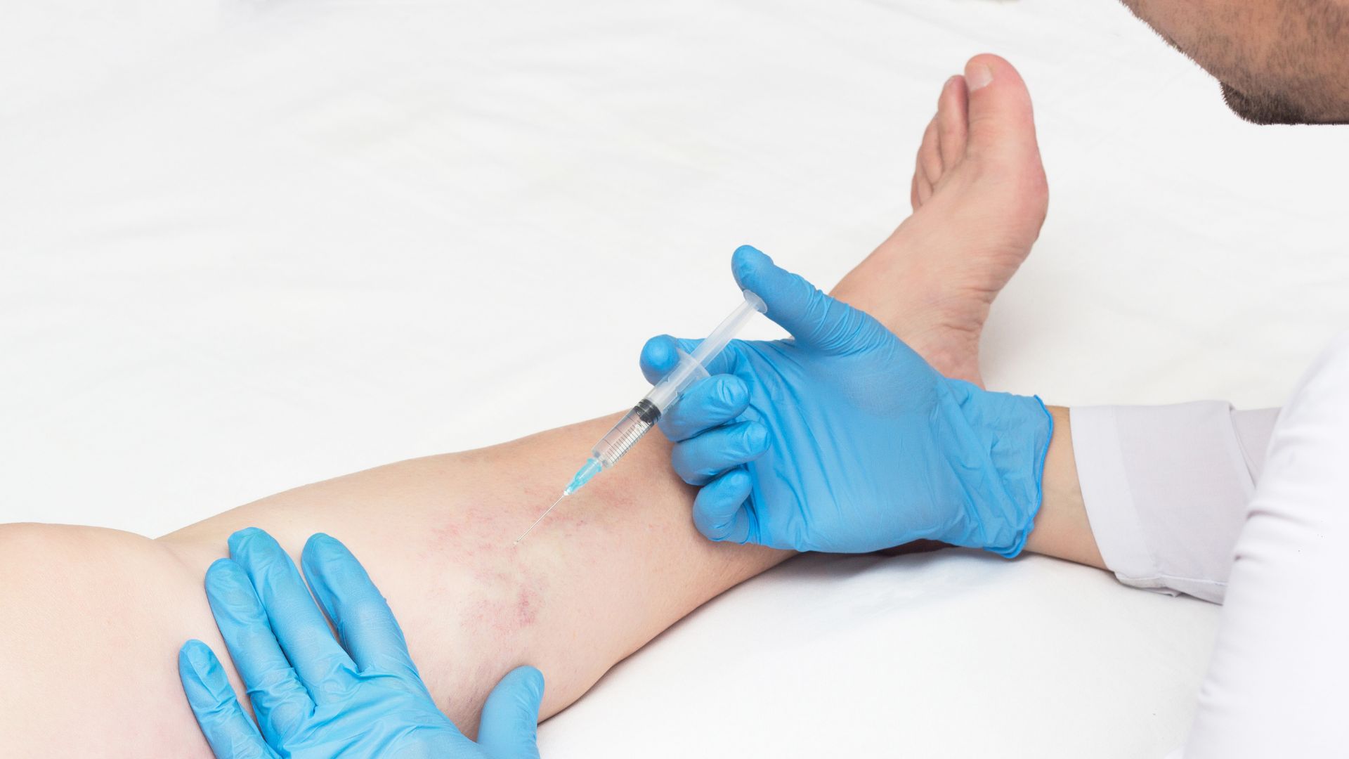 Come funziona la scleroterapia per le vene varicose