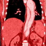 Aneurisma aorta addominale quando operare