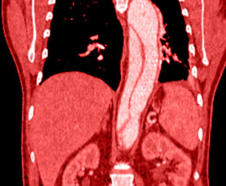 Aneurisma aorta addominale quando operare