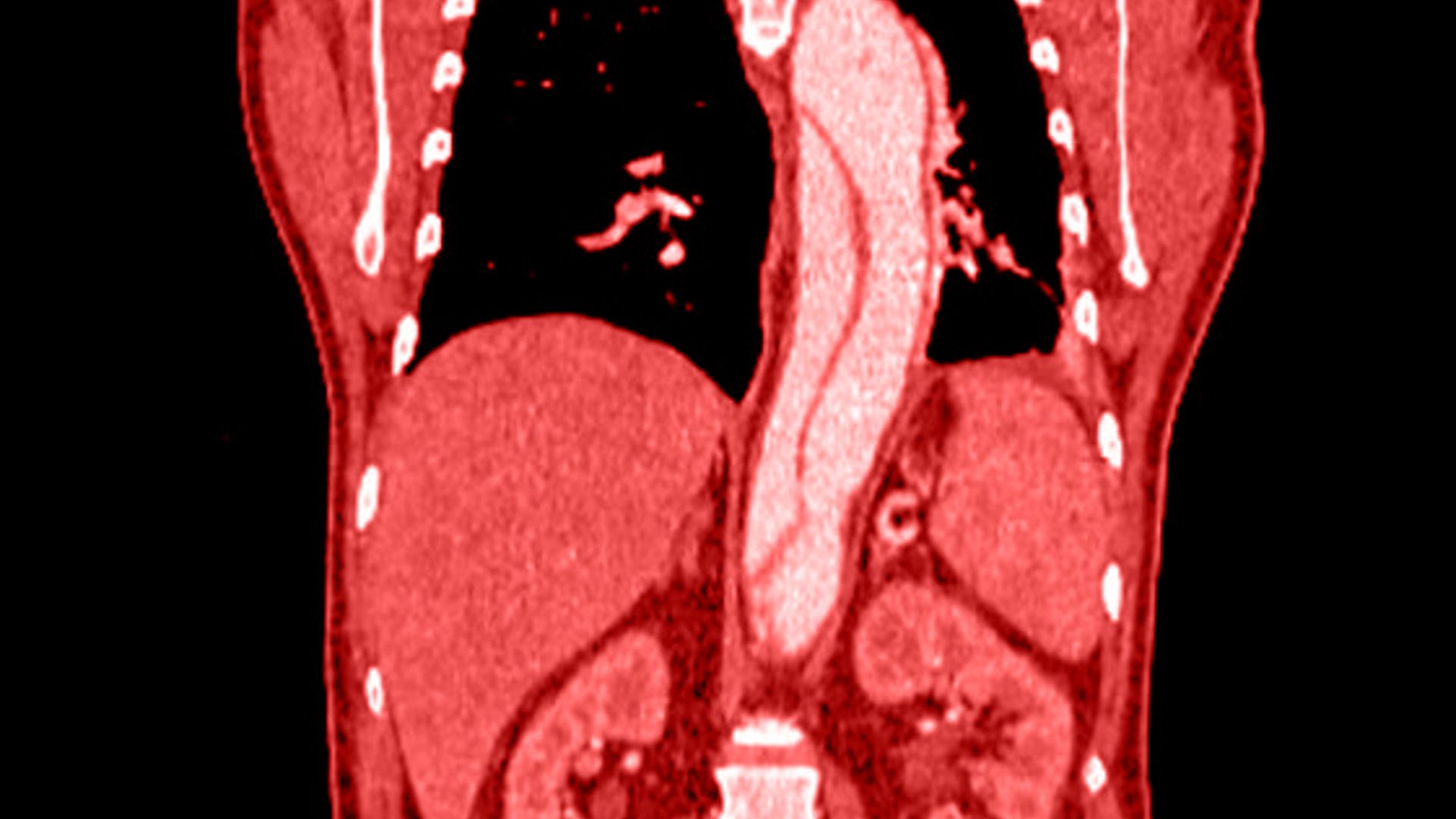 Aneurisma aorta addominale quando operare
