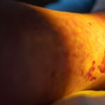 Ulcere vascolari gambe cure