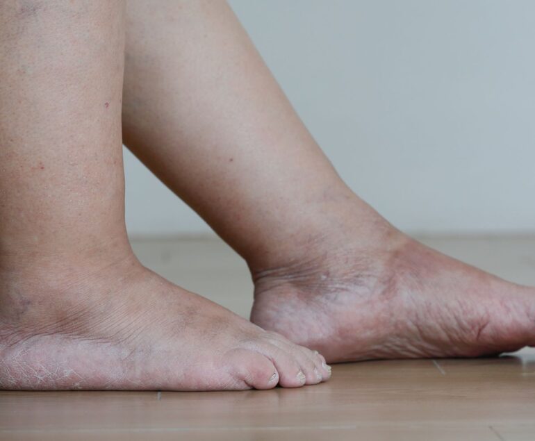 gambe gonfie e pesanti cause circolatorie