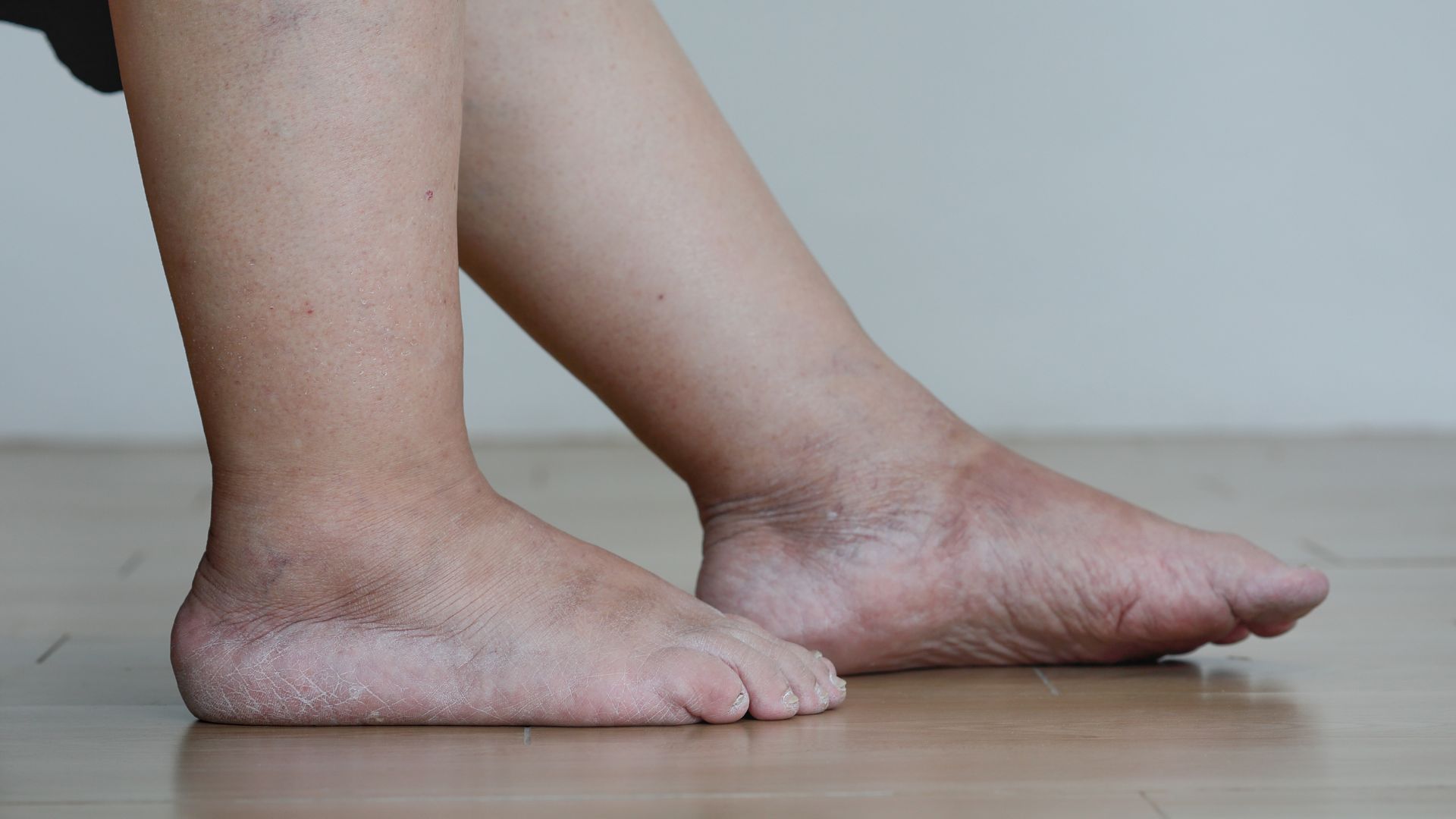 gambe gonfie e pesanti cause circolatorie