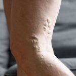 tromboflebite superficiale gamba cure