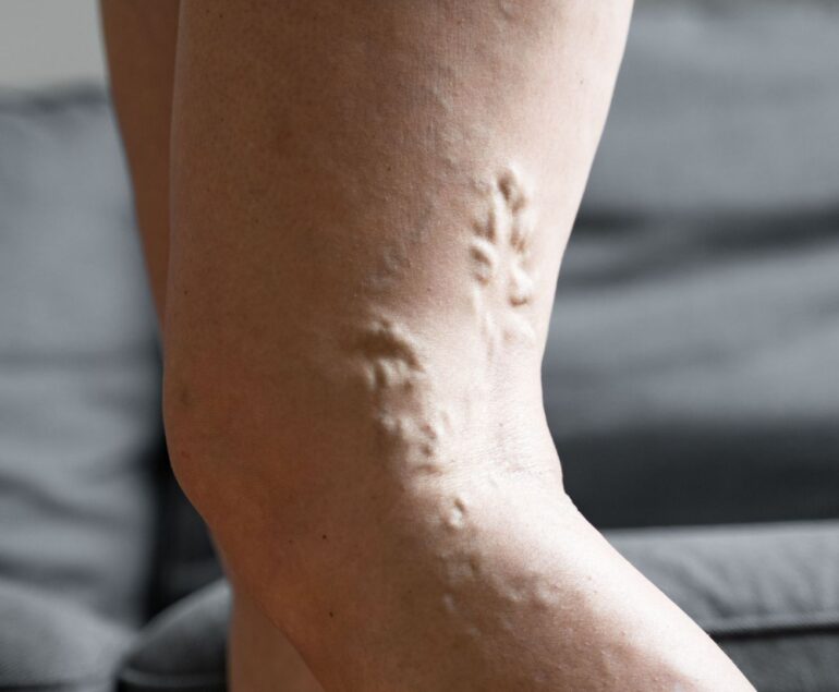 tromboflebite superficiale gamba cure
