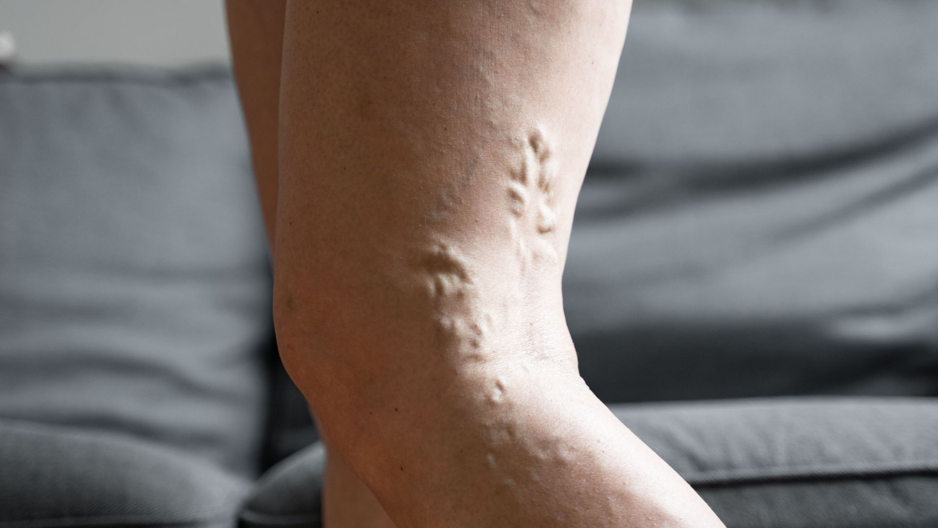 tromboflebite superficiale gamba cure