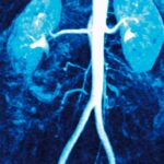 stenosi arteria renale cure