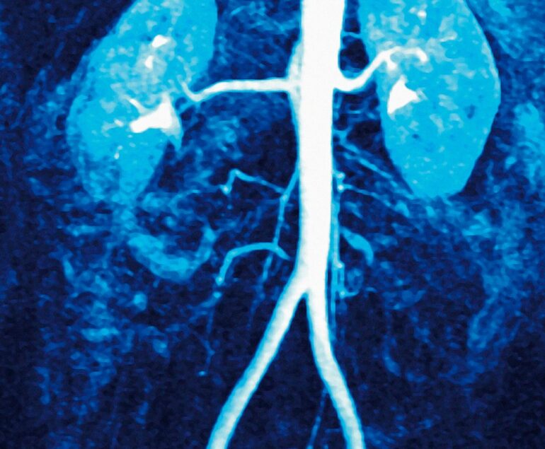 stenosi arteria renale cure
