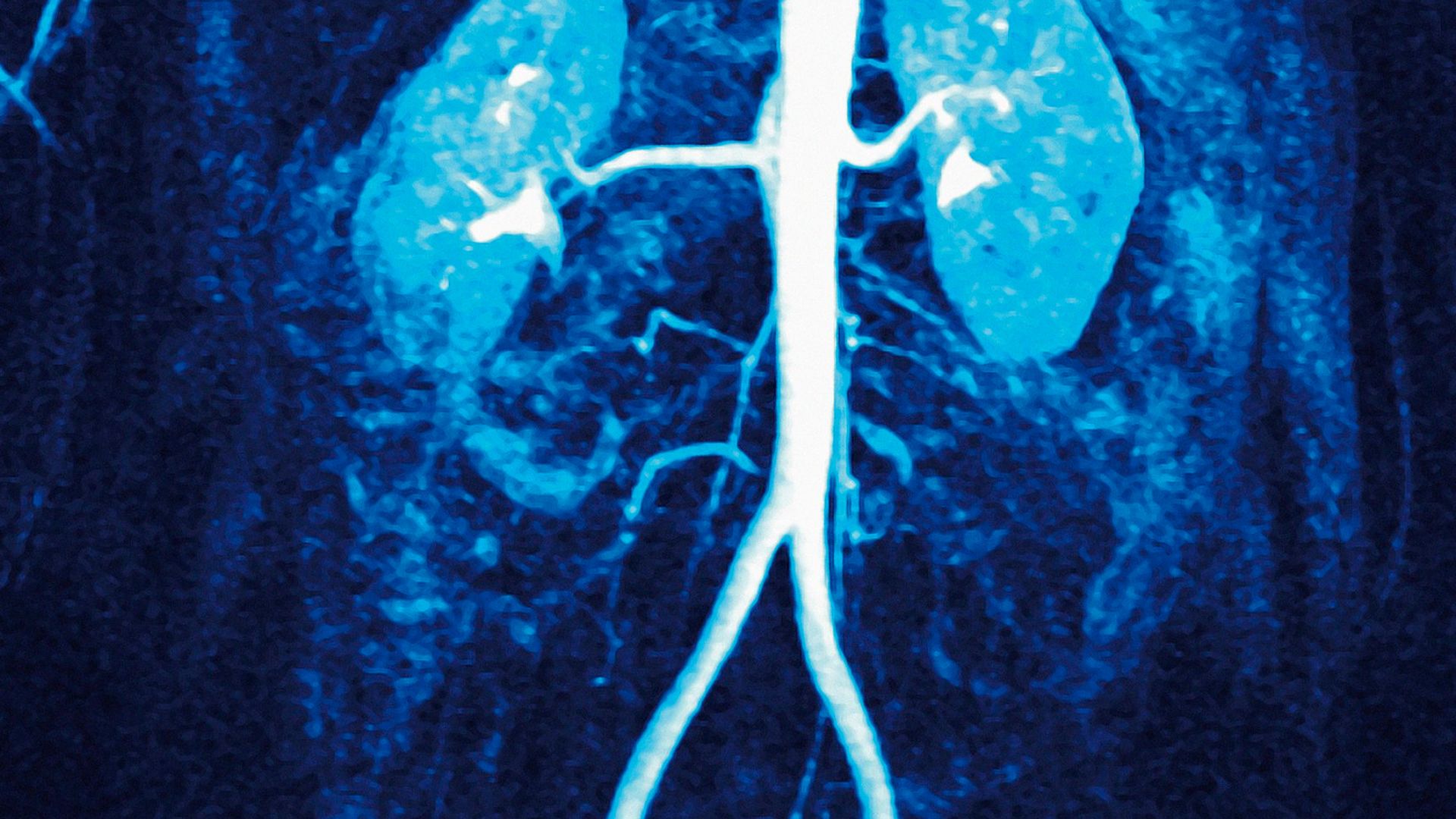 stenosi arteria renale cure